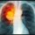 Vitamina D e risco de câncer de pulmão: uma ampla revisão e meta-análise